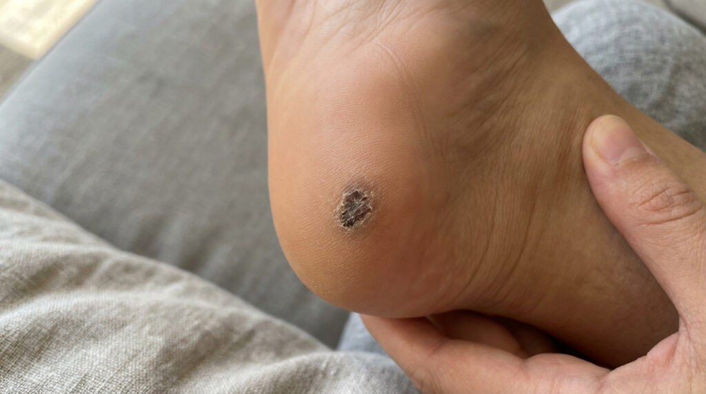 Gros plan sur une verrue plantaire foncée sur le talon d'un pied, indiquant une possible guérison, tenue par une main.