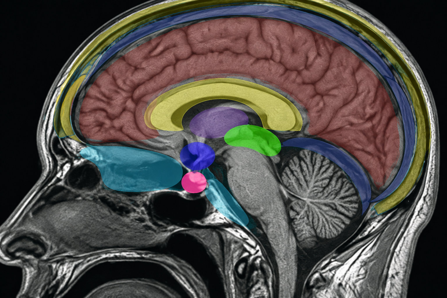 Coupe sagittale du cerveau sur une image médicale en niveaux de gris, avec différentes zones colorées en transparence.