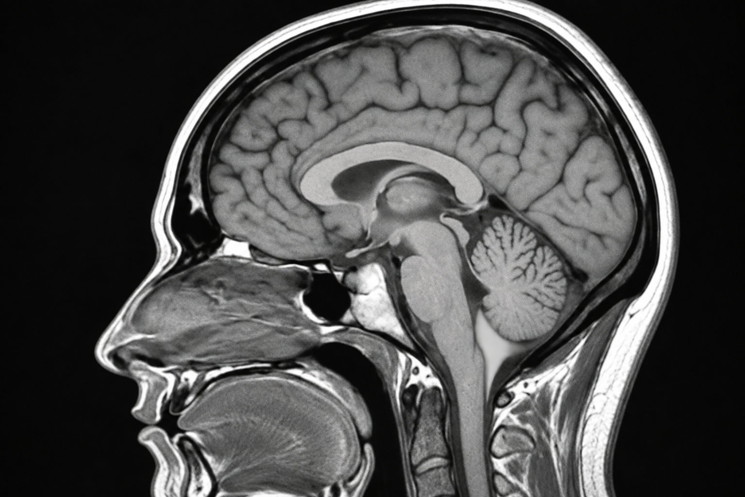 Coupe sagittale en noir et blanc d’une tête et du cerveau, montrant le cerveau, le cervelet et la moelle épinière.