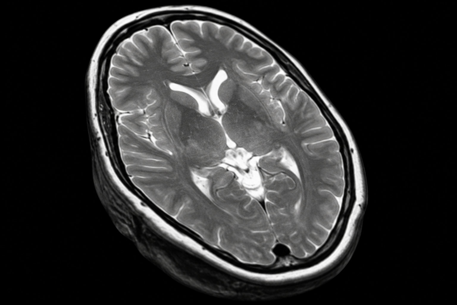 Image cérébrale en noir et blanc montrant une coupe du cerveau entouré par le crâne sur fond noir.